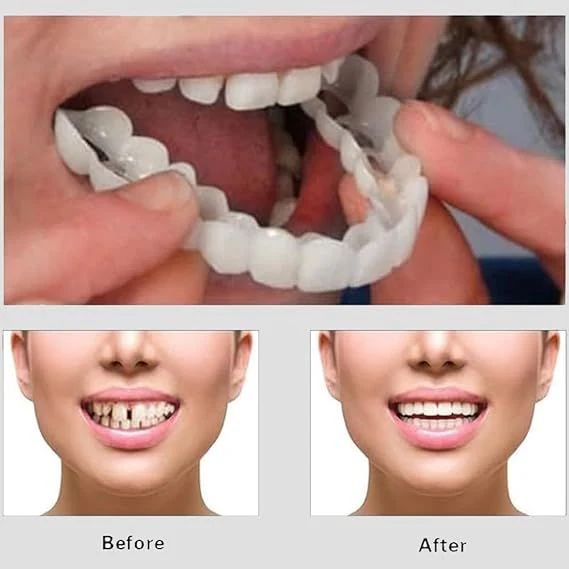 Snap On Smile Veneers Teeth For Men And Women